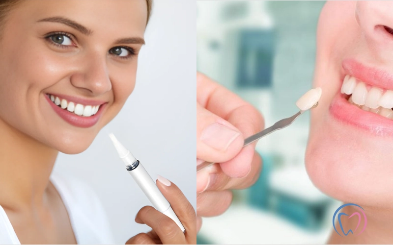 Whitening or Veneers_ Which is the Best Treatment for you_