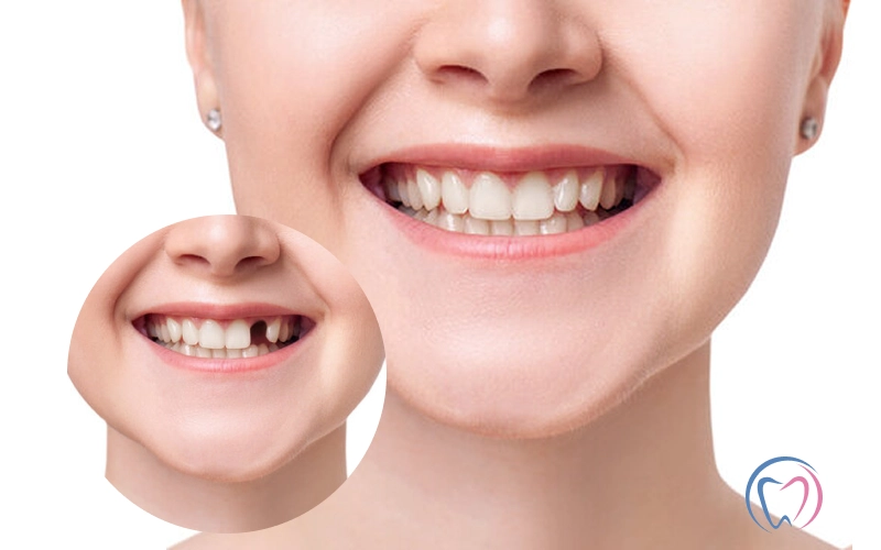 Why Your Missing Teeth Need to be Replaced ASAP!