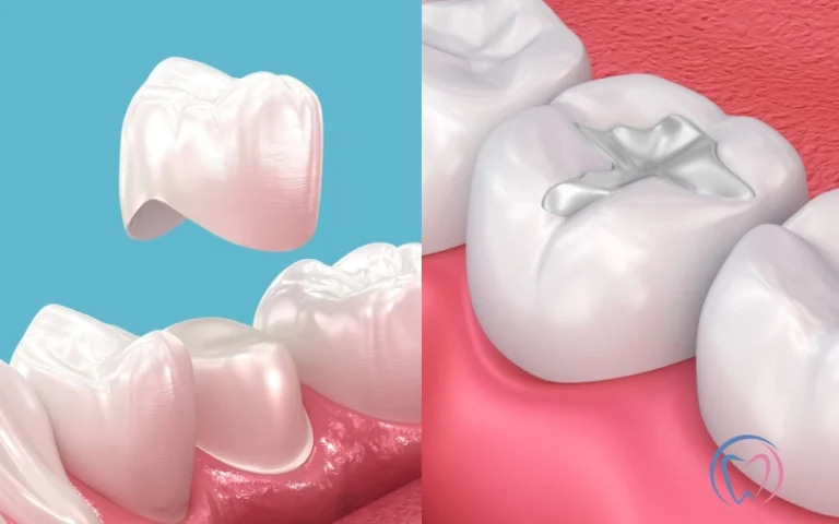Crown Vs Fillings_ What's the Best Option_
