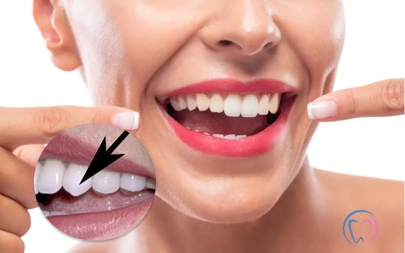 How To Fix Sharp Canine Teeth?