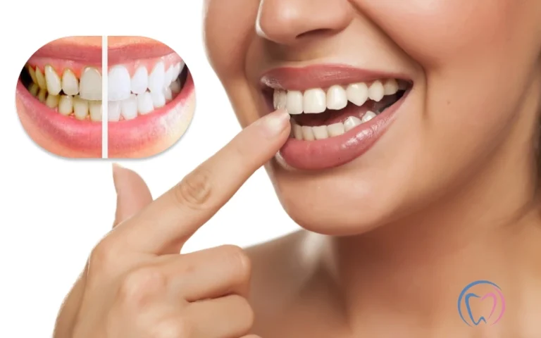 How To Remove Tartar And Plaque From Teeth_