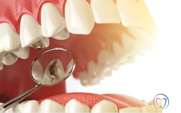 Can Tooth Decay be Reversed?