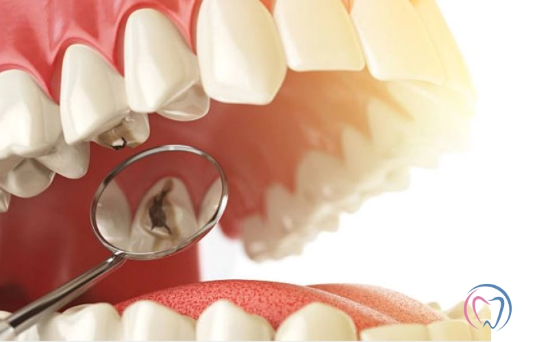 Can Tooth Decay be Reversed?