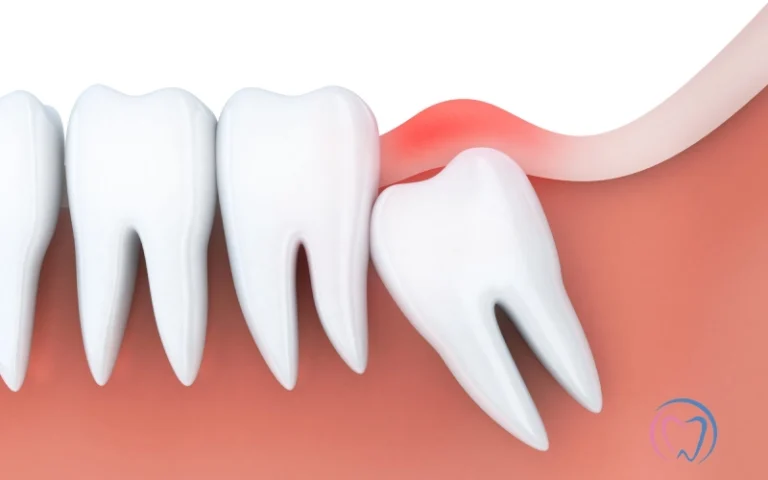 Wisdom Teeth Removal Costs