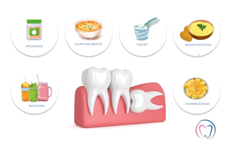 Best Foods After Wisdom Teeth Removal for Quick Recovery