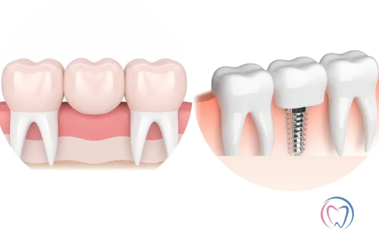 Dental Bridge Vs Dental Implants