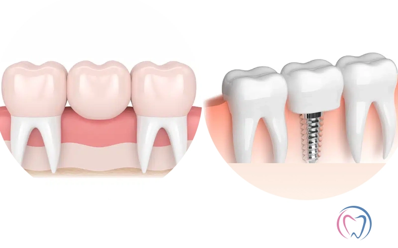 Dental Bridge Vs Dental Implants