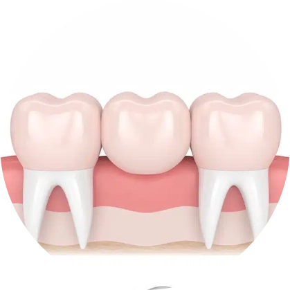 Dental Bridge