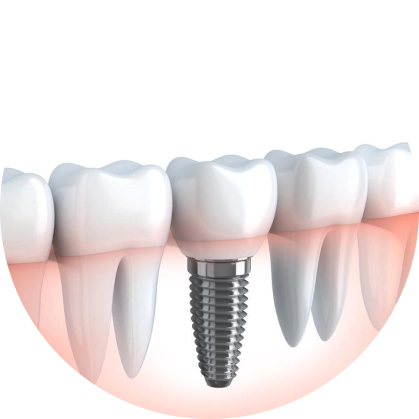 Dental Implants