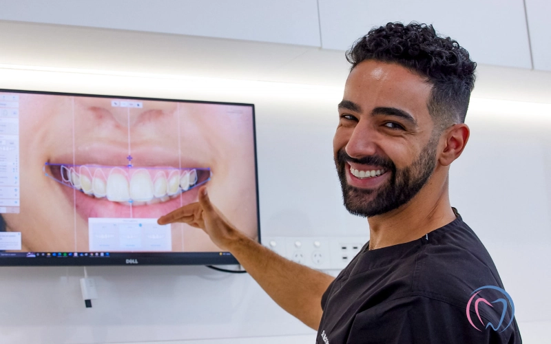 How Long Do Composite Veneers Last? Lifespan & Care Tips