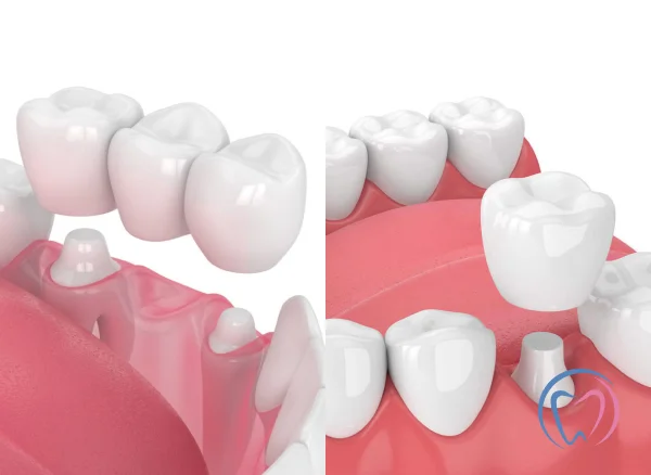 Dental Crowns & Bridges
